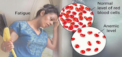 Anaemia (Low Haemoglobin) - Symptoms and Treatment